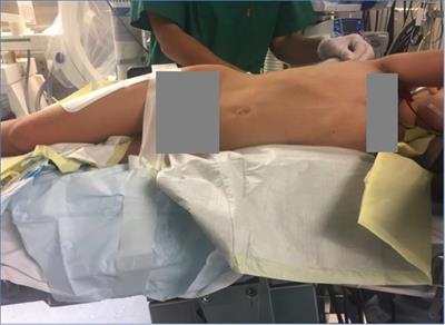 Transperitoneal Mini-Laparoscopic Pyeloplasty in Flank Position: A Safe Method for Infants and Young Adults